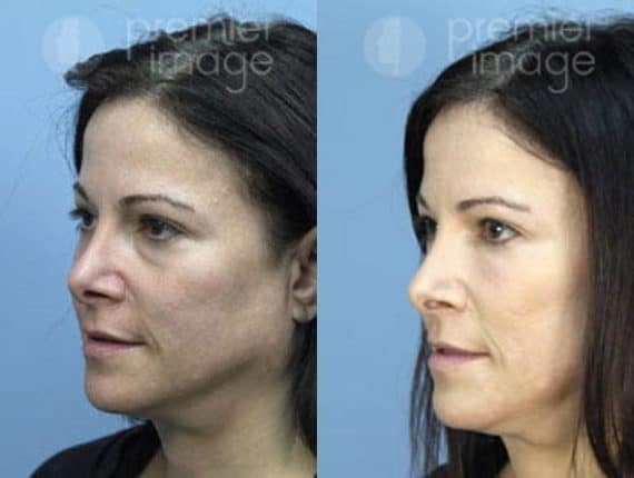 VUE Procedure Before and after photos in Sandy Springs, GA, Patient 16310