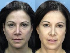 VUE Procedure Before and after photos in Sandy Springs, GA, Patient 16310