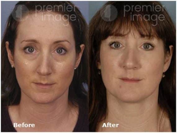 VUE Procedure Before and after photos in Sandy Springs, GA, Patient 16315