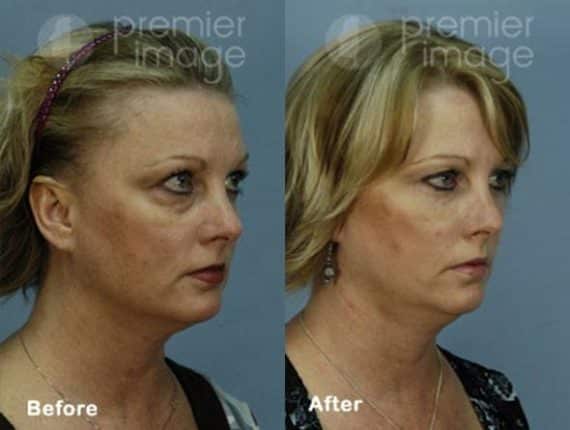 VUE Procedure Before and after photos in Sandy Springs, GA, Patient 16318