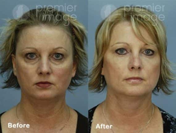 VUE Procedure Before and after photos in Sandy Springs, GA, Patient 16318