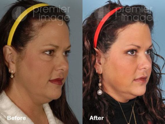 VUE Procedure Before and after photos in Sandy Springs, GA, Patient 16323