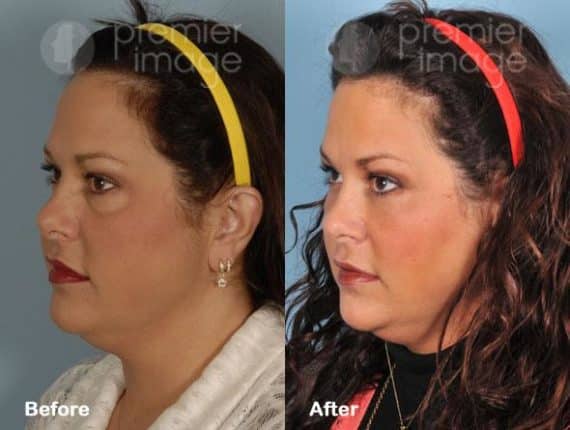 VUE Procedure Before and after photos in Sandy Springs, GA, Patient 16323