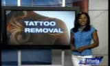 Eliminación de tatuajes y entrevistas de trabajo