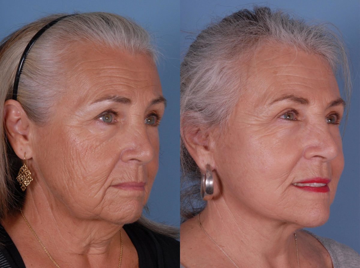 Patient 17222, Eyelid Surgery (Blepharoplasty) Before and After Photos Eyelid Surgery (Blepharoplasty) Before and After Photos in Sandy Springs, GA, Patient 17222