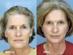 QT Mini-Facelift Before and after photos in Sandy Springs, GA, Patient 16096