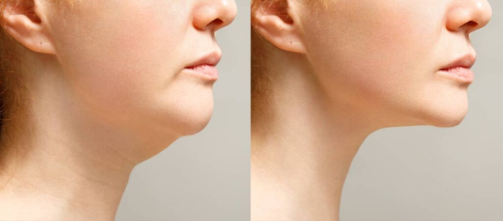 Kybella does not require anesthesia or operating room time, while submental liposuction typically requires both for patient comfort and safety