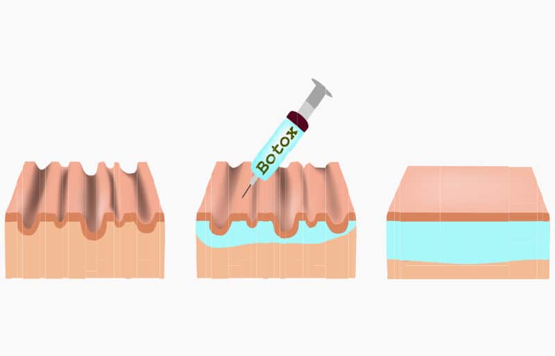 How Botox is Performed