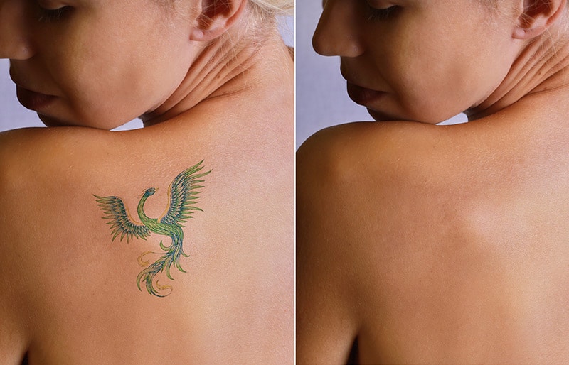 Laser Tattoo Removal Atlanta GA