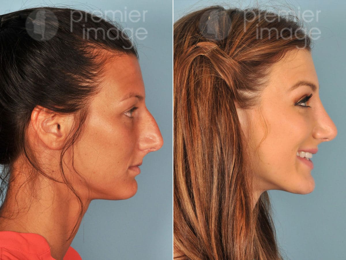 Rhinoplasty Before and after photos in Sandy Springs, GA, Patient 16059