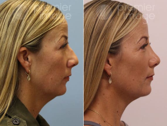 Rhinoplasty Before and after photos in Sandy Springs, GA, Patient 17207