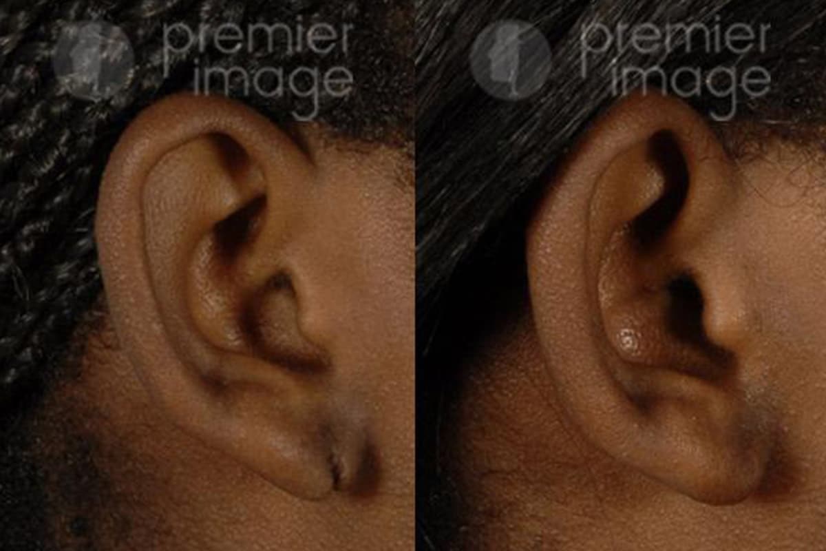 Repairing Gauge or Stretched Earlobes with Plastic Surgery