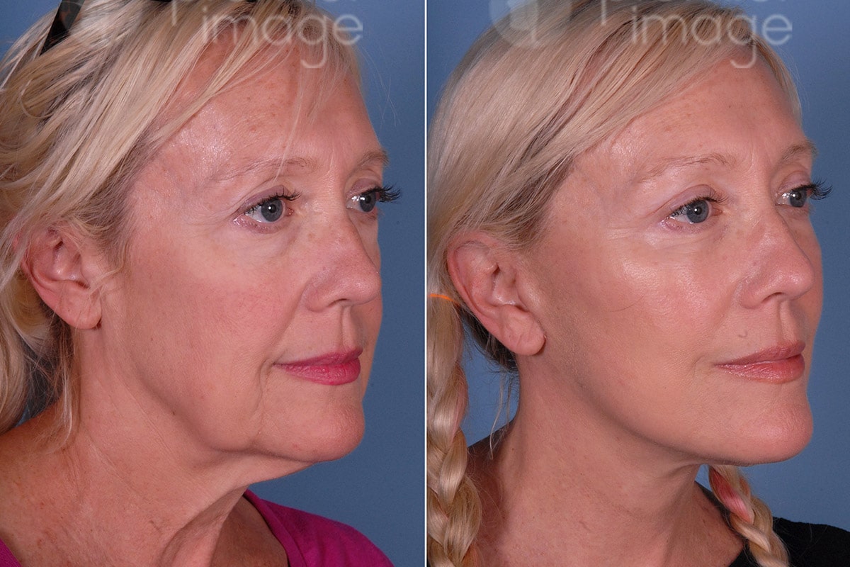 https://www.picosmeticsurgery.com/wp-content/uploads/2020/08/mini-facelift-dr-louis-dejoseph-atlanta-ga.jpg