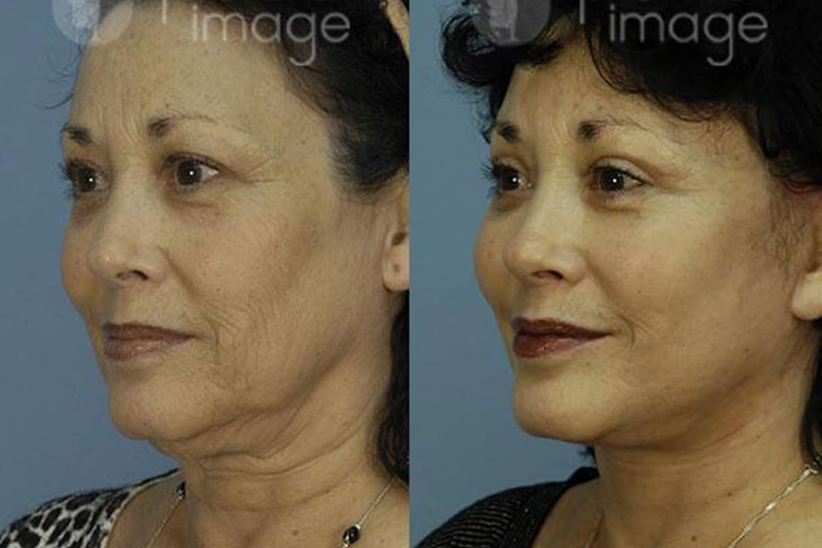 Neck Lift Atlanta, GA Lower Rhytidectomy & Plastysmaplasty Surgery