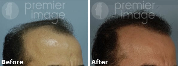 Hair Transplant Before and after photos in Sandy Springs, GA, Patient 15913