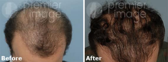 Hair Transplant Before and after photos in Sandy Springs, GA, Patient 15913