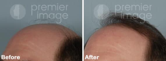 Hair Transplant Before and after photos in Sandy Springs, GA, Patient 15920