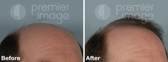 Hair Transplant Before and after photos in Sandy Springs, GA, Patient 15920