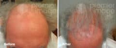 Hair Transplant Before and after photos in Sandy Springs, GA, Patient 15925