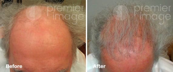 Hair Transplant Before and after photos in Sandy Springs, GA, Patient 15925