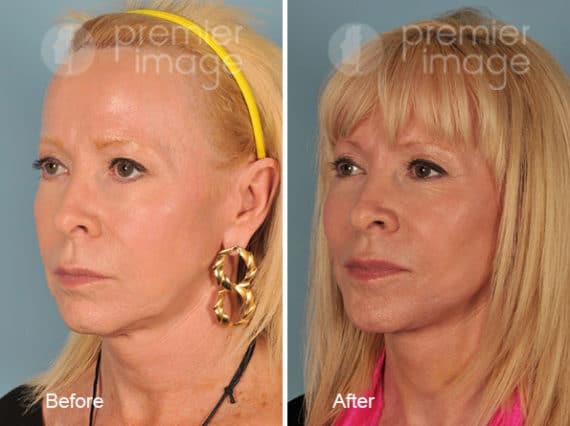 QT Mini-Facelift Before and after photos in Sandy Springs, GA, Patient 16180