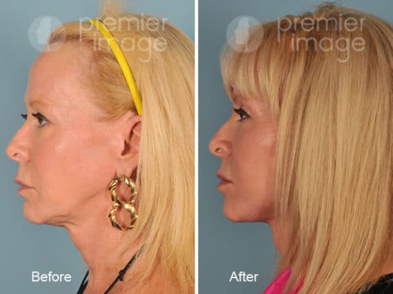 QT Mini-Facelift Before and after photos in Sandy Springs, GA, Patient 16180