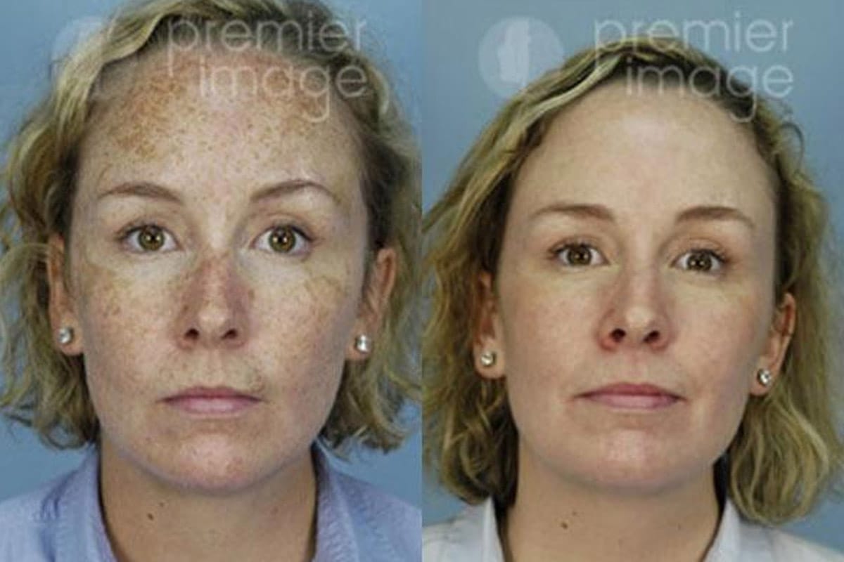 CO2 Laser Facial Rejuvenation: Fix Fine Lines, Wrinkles, Sun Damage &  Stretch Marks