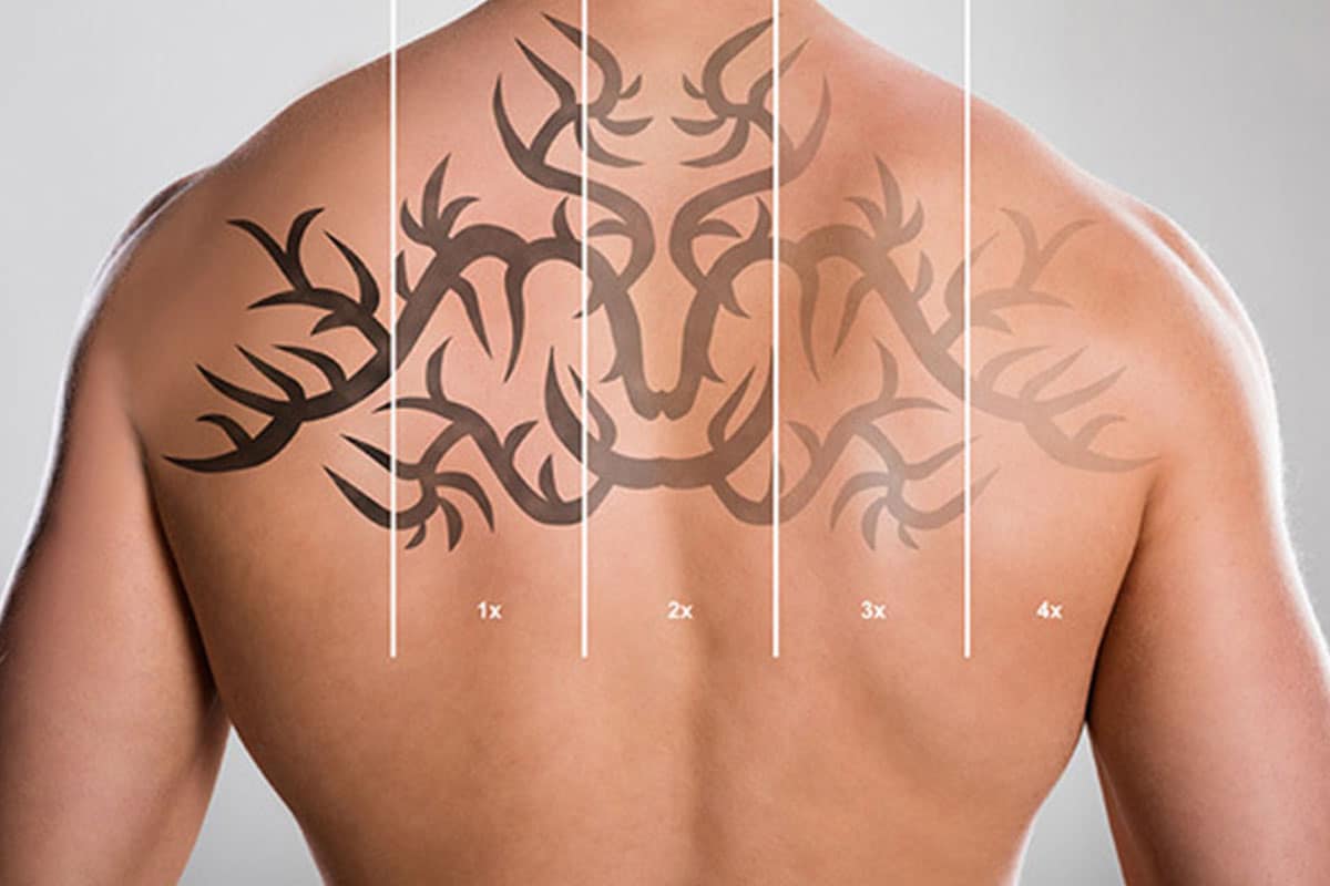 No More Tattoo Regrets With The New Laser Tattoo Removal Technology