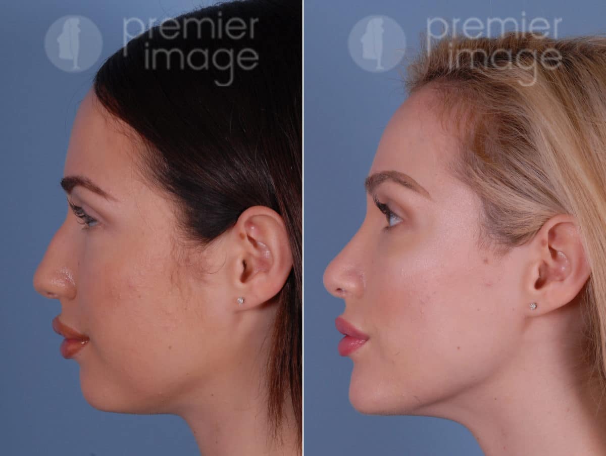 Chin Augmentation Rhinoplasty Before And After Photos Sandy Springs