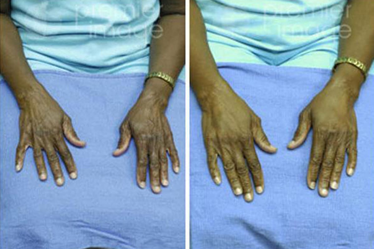 Hand Rejuvenation Atlanta, GA