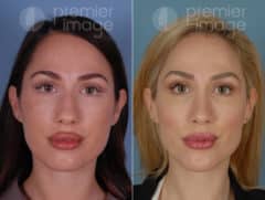 Chin Augmentation Before and after photos in Sandy Springs, GA, Patient 17193