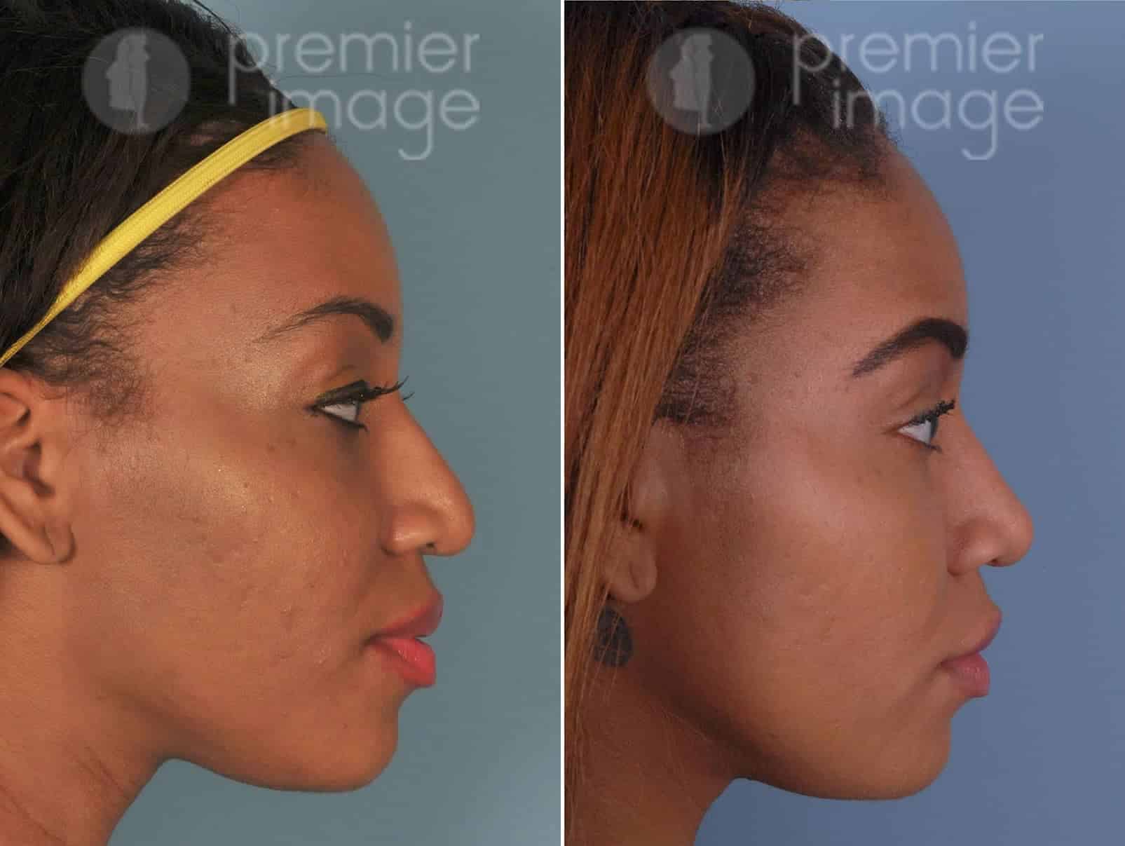  Rinoplastia Fotos Antes y Después en Sandy Springs, GA, Patient 17203