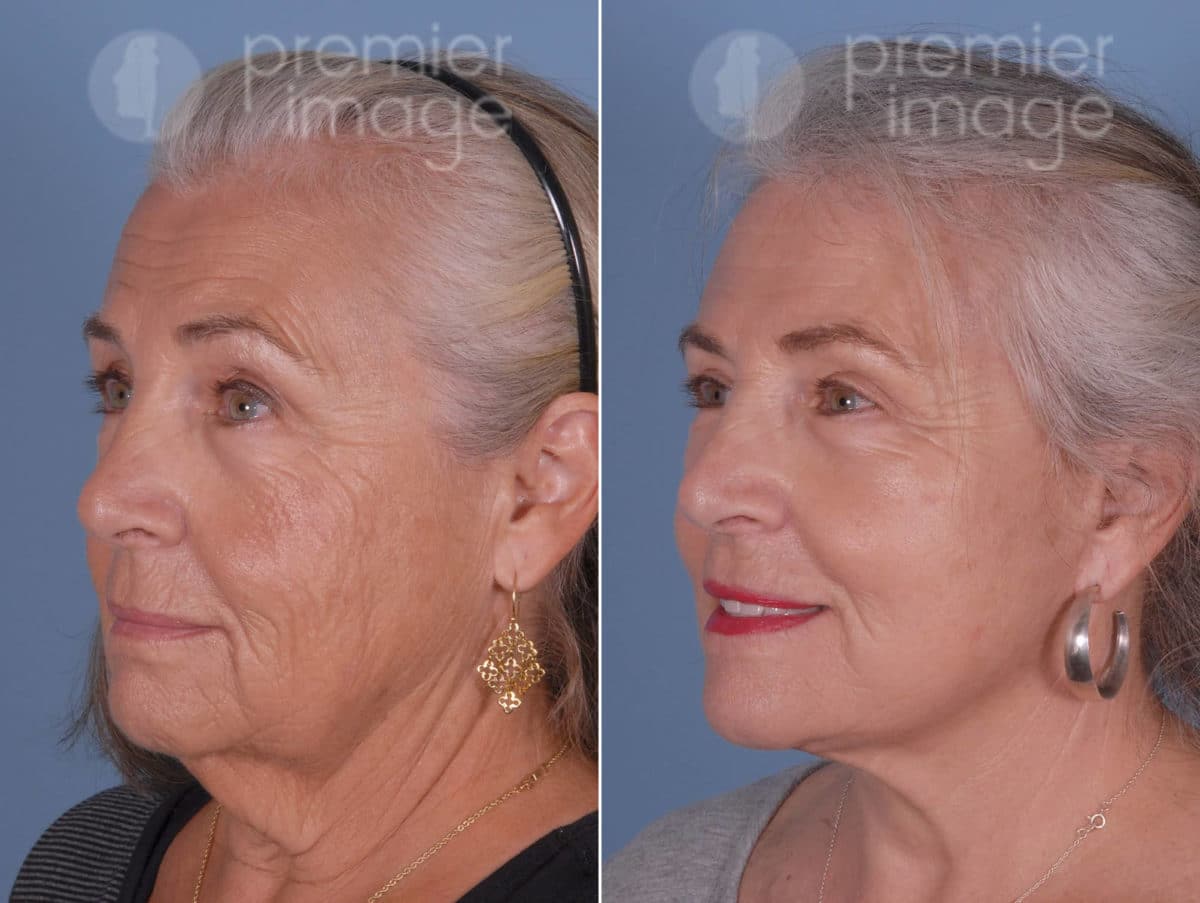  Cirugía de Párpados (Blefaroplastia) Fotos Antes y Después en Sandy Springs, GA, Patient 19151