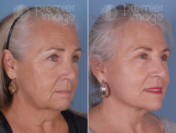  Cirugía de Párpados (Blefaroplastia) Fotos Antes y Después en Sandy Springs, GA, Patient 19151