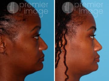 Rhinoplasty Before and after photos in Sandy Springs, GA, Patient 25825