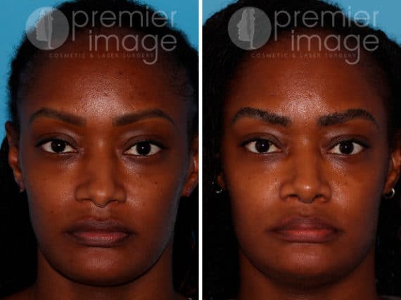 Rhinoplasty Before and after photos in Sandy Springs, GA, Patient 25825