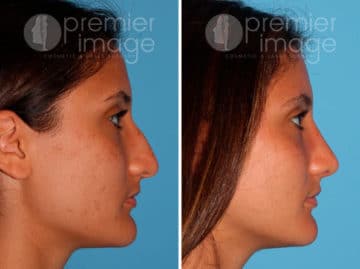 Rhinoplasty Before and after photos in Sandy Springs, GA, Patient 25846