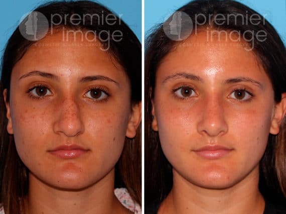 Rhinoplasty Before and after photos in Sandy Springs, GA, Patient 25846