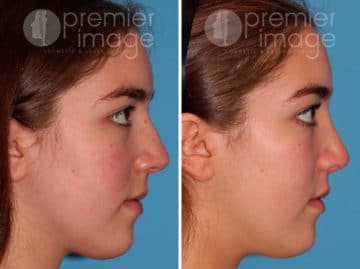 Rhinoplasty Before and after photos in Sandy Springs, GA, Patient 25847
