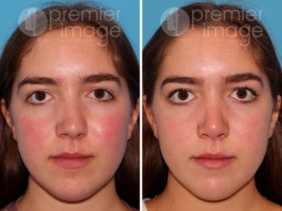 Rhinoplasty Before and after photos in Sandy Springs, GA, Patient 25847