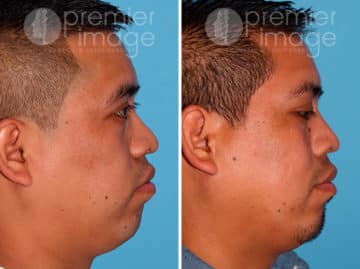 Rhinoplasty Before and after photos in Sandy Springs, GA, Patient 25872