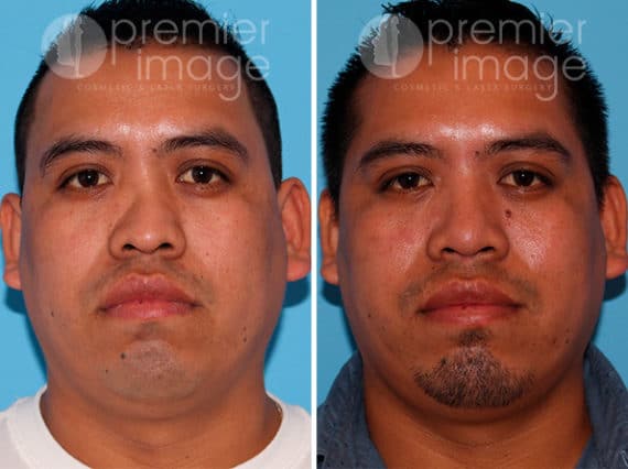 Rhinoplasty Before and after photos in Sandy Springs, GA, Patient 25872
