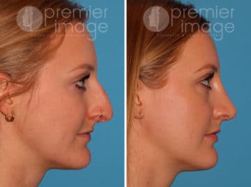 Rhinoplasty Before and after photos in Sandy Springs, GA, Patient 25873
