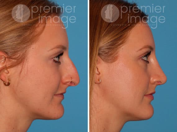 Rhinoplasty Before and after photos in Sandy Springs, GA, Patient 25873