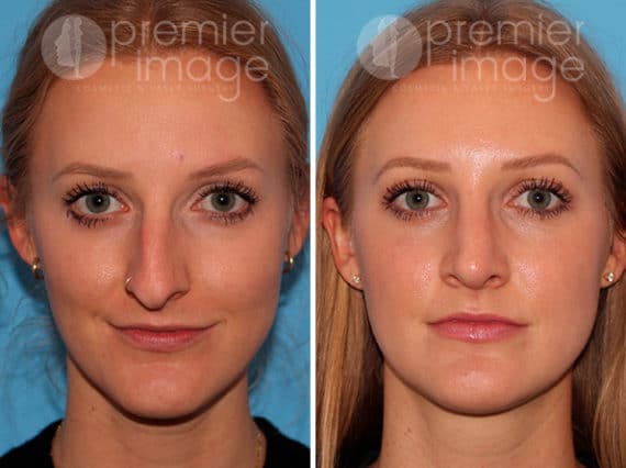 Rhinoplasty Before and after photos in Sandy Springs, GA, Patient 25873