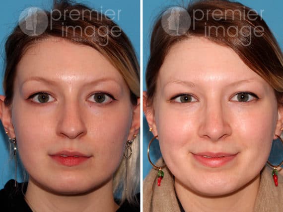 Rhinoplasty Before and after photos in Sandy Springs, GA, Patient 25874