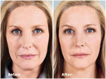 Injectables and Fillers Before and after photos in Sandy Springs, GA, Patient 15931