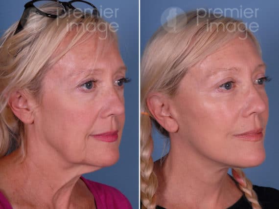 Eyelid Surgery (Blepharoplasty) Before and after photos in Sandy Springs, GA, Patient 17211