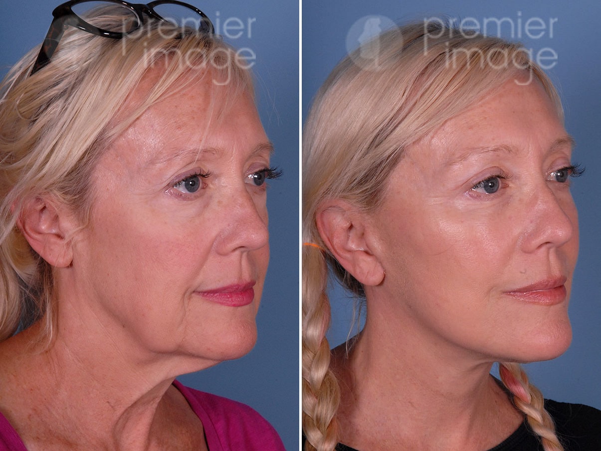 Eyelid Surgery (Blepharoplasty) Before and after photos in Sandy Springs, GA, Patient 17211