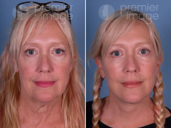 Eyelid Surgery (Blepharoplasty) Before and after photos in Sandy Springs, GA, Patient 17211